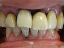 歯周病の写真